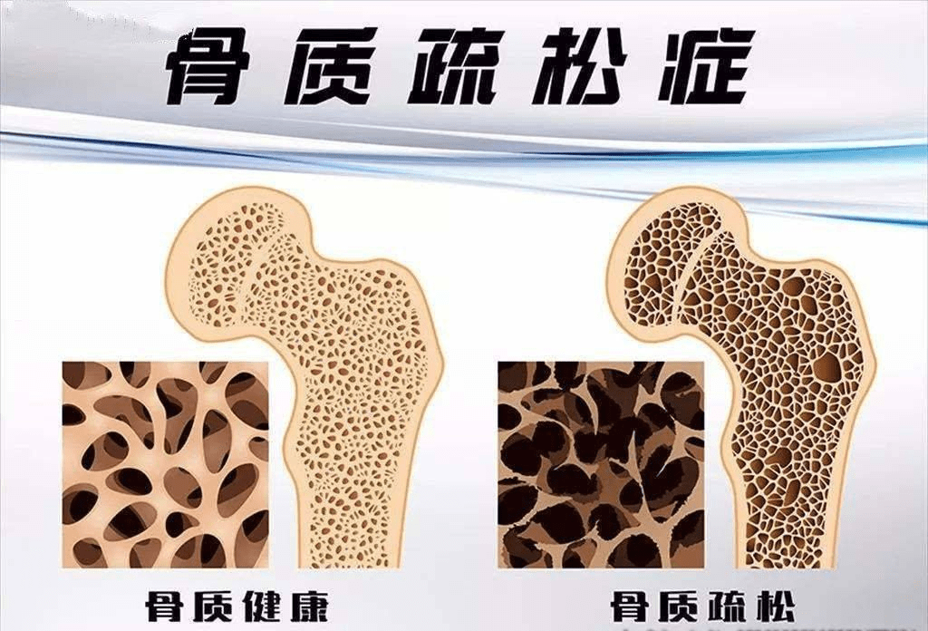 骨质疏松预防需要注意哪些营养补充