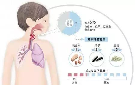 家庭急救，异物卡喉应急处理方法