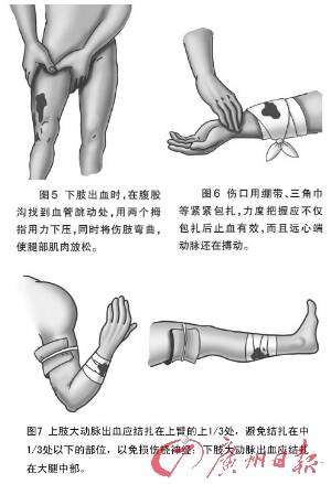 家庭急救指南，切割伤的止血与急救技巧