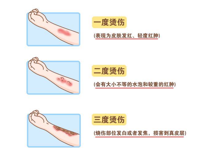 小面积烧烫伤伤口急救处理指南，关键步骤与注意事项